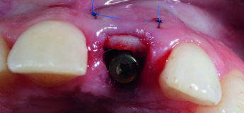 Пластика мягких тканей полости рта: от коррекции десневой улыбки до устранения рецессий (теория)