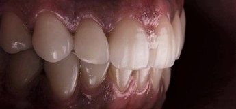 Стоматология – это окклюзия. Функциональное размыкание зубов по М. Кувате (FDO)