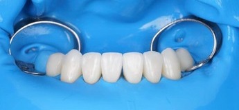 Препарирование передних зубов под цельнокерамические реставрации